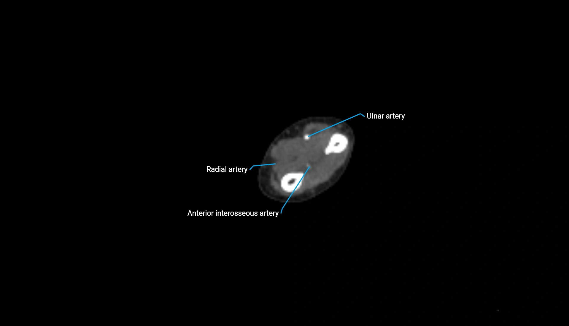 CTA upper limb axial cross sectional anatomy labelled image 119 (2).webp